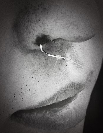 ▲▼一名患者的鼻翼被魚鉤勾傷。（圖／翻攝自醫師田知學臉書）