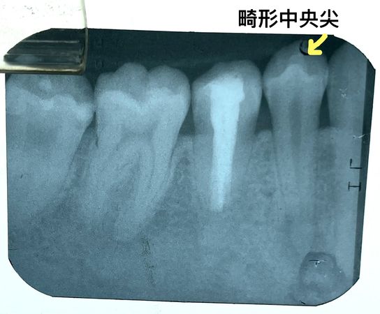 ▲▼畸形中央尖示意圖。（圖／徐維敏醫師提供）