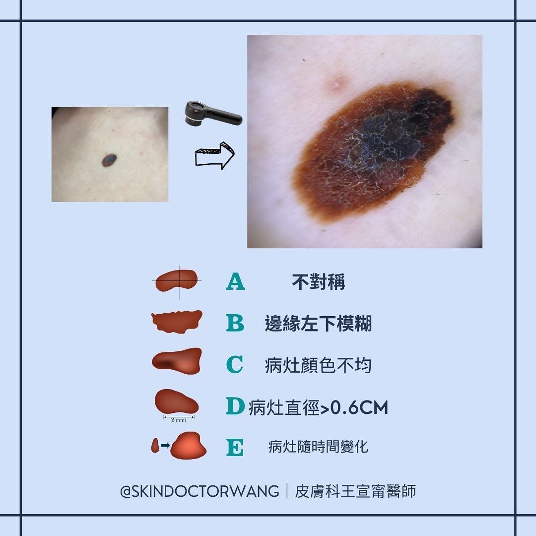 ▲▼2年輕人長「奪命黑痣」！醫一看搖頭　示警5大危險特徵。（圖／王宣甯醫師授權提供）