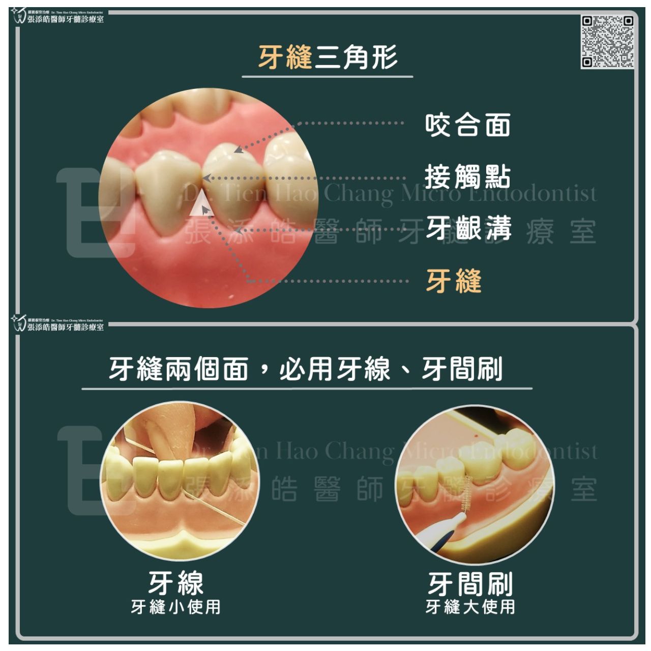 減少牙縫蛀牙，必用牙線、牙間刷（圖／張添皓醫師顯微根管治療中心提供）