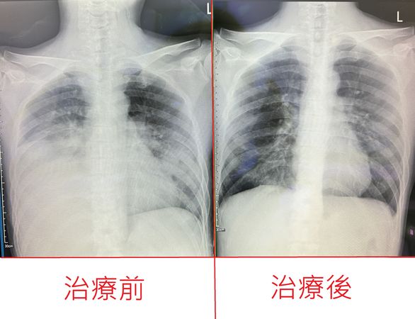 ▲▼患者確診新冠肺炎，並沒有出現發燒、喉嚨痛等典型症狀，送醫檢查發現兩側肺部嚴重發白。（圖／烏日林新醫院提供）