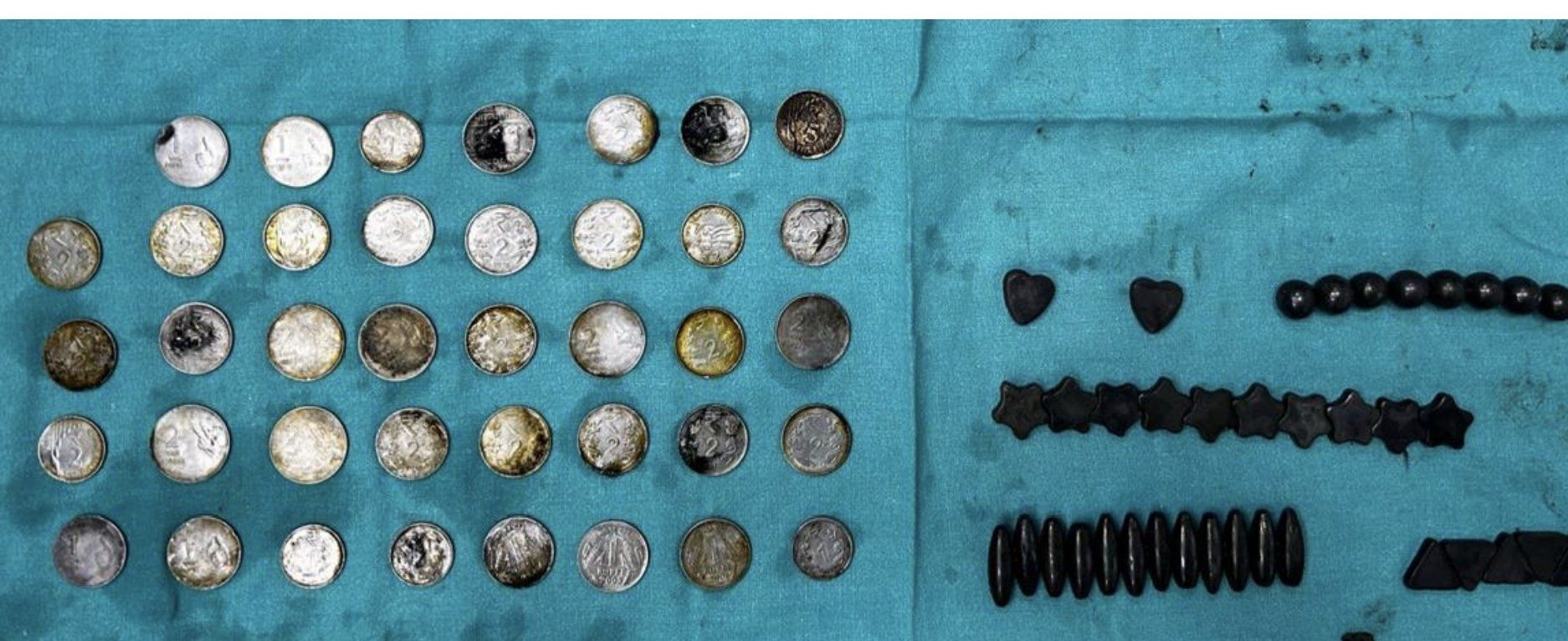 ▲▼印度26歲男子吞下含有鋅的硬幣、磁鐵。（圖／翻攝自X）