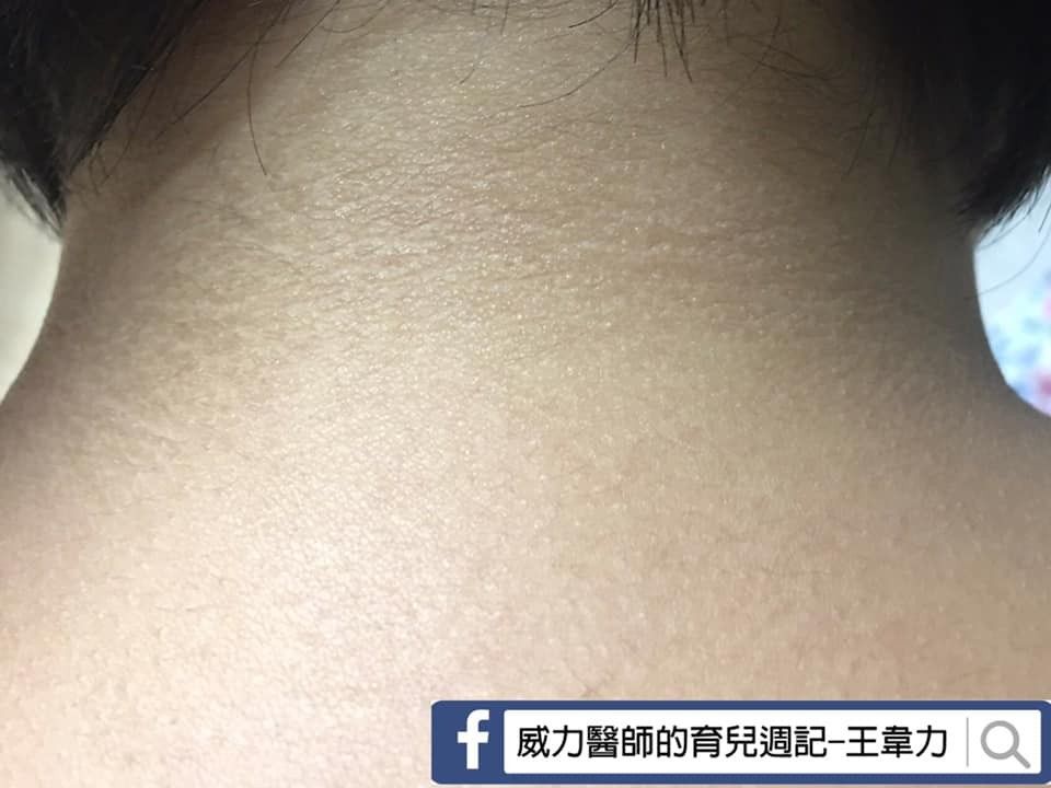 ▲脖子背後出現黑色的汙垢洗不掉，當心是身體代謝出問題。（圖／王韋力醫師提供）