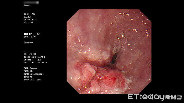 ▲圖為55歲男性食道癌患者，放化療前上內視鏡檢查消化道，發現食道中下段存在腫瘤。(圖／慈濟醫學中心提供，下同）