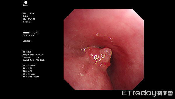 ▲圖為55歲男性食道癌患者，放化療前上內視鏡檢查消化道，發現食道中下段存在腫瘤。(圖／慈濟醫學中心提供，下同）