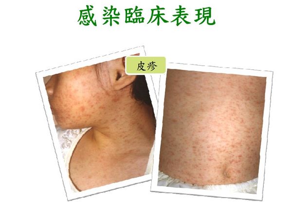 ▲▼麻疹臨床症狀。（圖／疾管署提供）