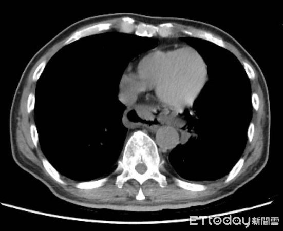 ▲電腦斷層掃描顯示遠端食道裂傷。（圖／記者許宥孺翻攝）