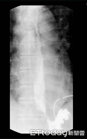▲術後3周食道攝影顯影劑無外漏、癒合良好。（圖／記者許宥孺翻攝）