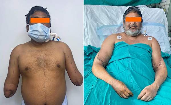 [新聞] 火車輾斷手　印度男畫家「移植女性雙臂」