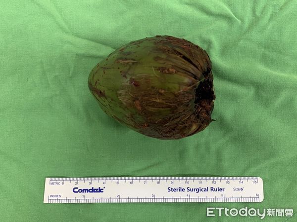 [新聞] 肛門塞整顆椰子!高雄男2天無法排尿就醫