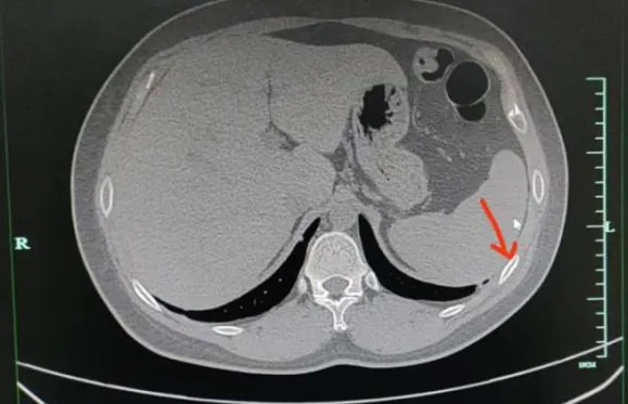 ▲30歲男子咳斷2根肋骨。（圖／翻攝自閩南網）
