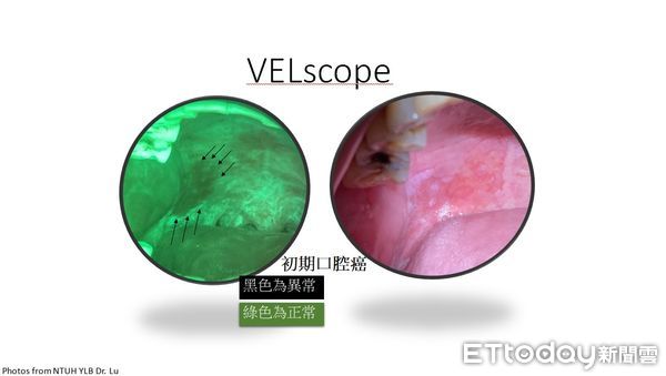 ▲台大醫院雲林分院牙科部呂佩軒醫師表示，自體螢光設備對於偵測口腔癌、原位癌以及高度上皮變異的癌前病變具有接近100%的敏感度。（圖／記者蔡佩旻翻攝）