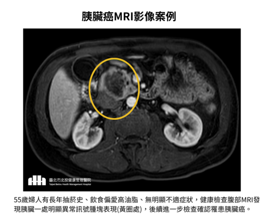 ▲▼胰臟癌MRI影像案例。（圖／北投健康管理醫院提供）