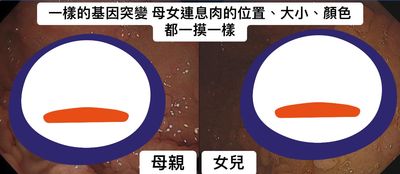 照胃鏡「密密麻麻息肉」 醫：我真的嚇到！跟她媽媽一模一樣