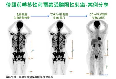 她年輕型乳癌+轉移！抑制劑治療骨頭處癌細胞全消失 健保擴大給付