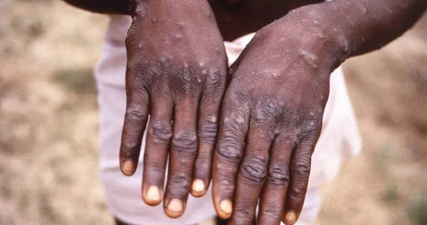 非洲剛果共和國的卡米圖加鎮發現新型M痘變異株。（圖／達志／美聯社）