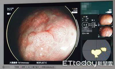 聖馬爾定醫院採用先進AI腸胃內視鏡 讓大腸癌無所遁形