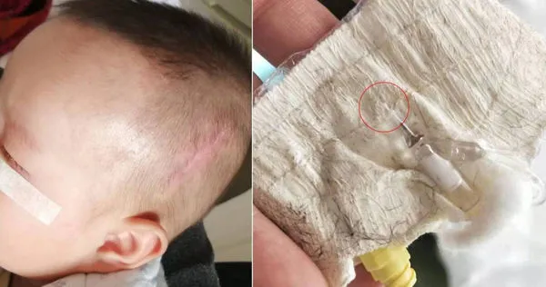 陝西一名男童，出生5個月動手術時，醫護竟失誤把針頭導管留在體內。（圖／翻攝自瀟湘晨報）