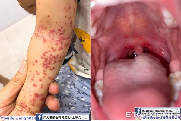 ▲▼腸病毒停課！媽怨才2個「長一點點疹子」嚴重嗎　醫PO染病圖網炸鍋。（圖／王韋力醫師授權提供）