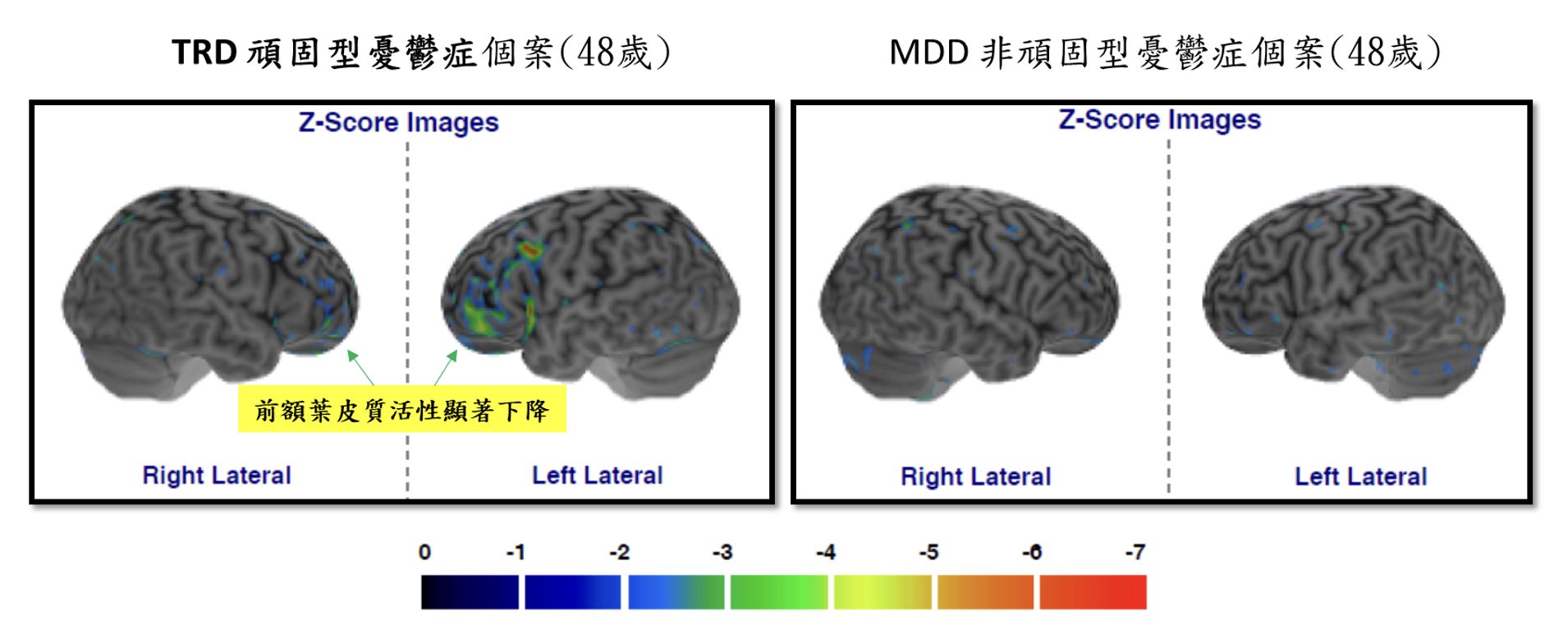 ▲▼北榮研究證實頑固型憂鬱症具家族遺傳性。（圖／台北榮總提供）