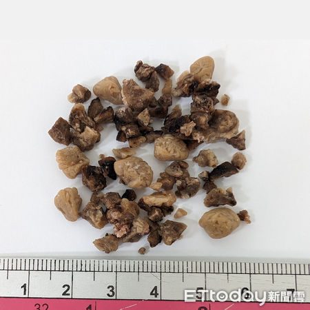 ▲東港安泰醫院微創雙鏡聯合手術一次清除鹿角結石             。（圖／東港安泰醫院提供）