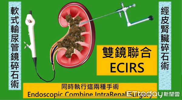 ▲東港安泰醫院微創雙鏡聯合手術一次清除鹿角結石             。（圖／東港安泰醫院提供）