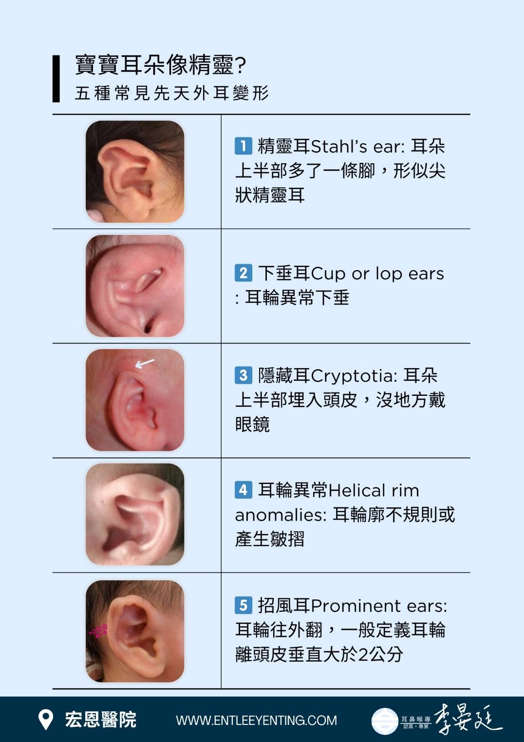 5種常見先天性耳朵變形。（圖／記者趙于婷攝）