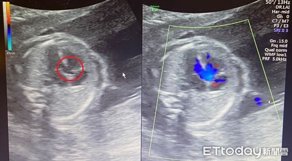 ▲胎兒5個月多時，由賴錫鉅醫師以心臟超音波檢查發現有主動脈跨坐在心室中隔上的情形。（圖／記者游瓊華翻攝）