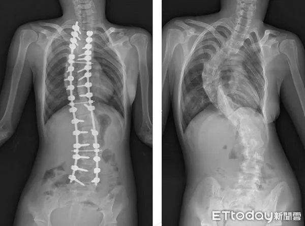 ▲脊椎側彎。（圖／記者游瓊華翻攝）