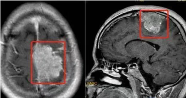 男穿不住夾腳拖　一檢查竟是6公分腦瘤惹的禍