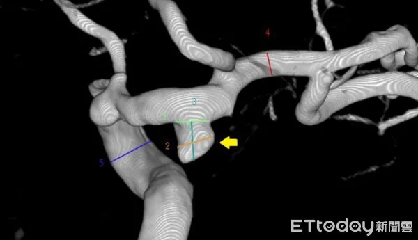 台北慈濟醫院影像醫學部神經影像科主任阮郁修,動脈瘤。（圖／醫院提供）