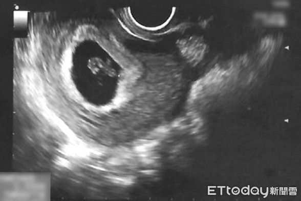 ▲陳寶珠主任表示，胚胎著床後在子宮腔內出現血塊的情況，普通的受精懷孕也可能發生，且目前成因不明。（圖／慈濟醫學中心提供，下同）