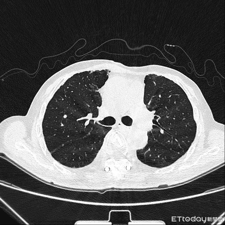 China National Cancer Center reports thyroid cancer in third place