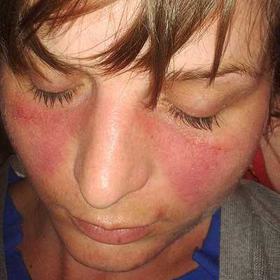 蝴蝶斑是紅斑性狼瘡的典型症狀之一，患者會在法令紋以上的兩頰浮出紅斑。（圖／翻攝自維基百科）