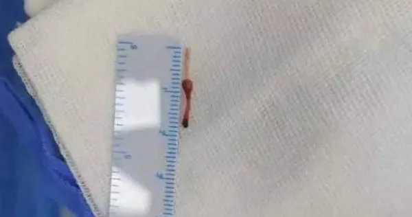 1.5cm針頭導管斷在嬰兒血管。（圖／翻攝自微博）