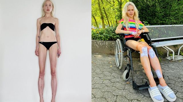 ▲▼德國32歲女膜費歇爾接受身高手術，成為183公分高的長腿妹。（圖／翻攝自Instagram）