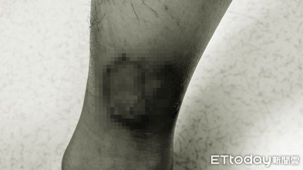 他腳發黑爛掉！「糖尿病足潰瘍」截肢風險24%　醫曝難癒合原因