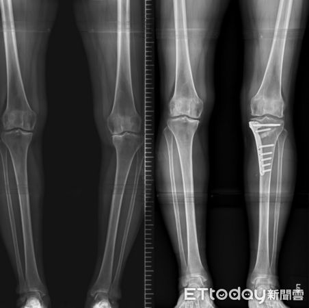 Ｏ型腿導致膝軟骨長期磨損。（圖／台北慈濟醫院提供）