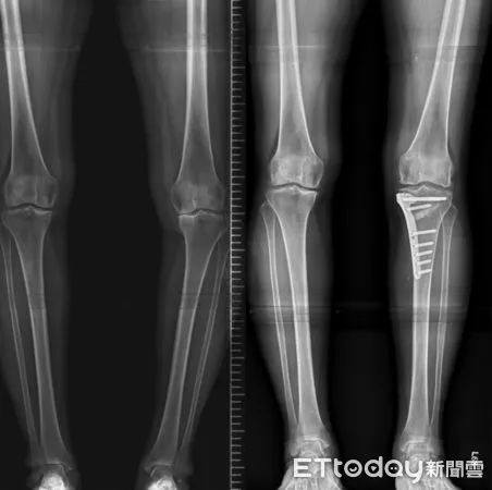 Ｏ型腿導致膝軟骨長期磨損。（圖／台北慈濟醫院提供）