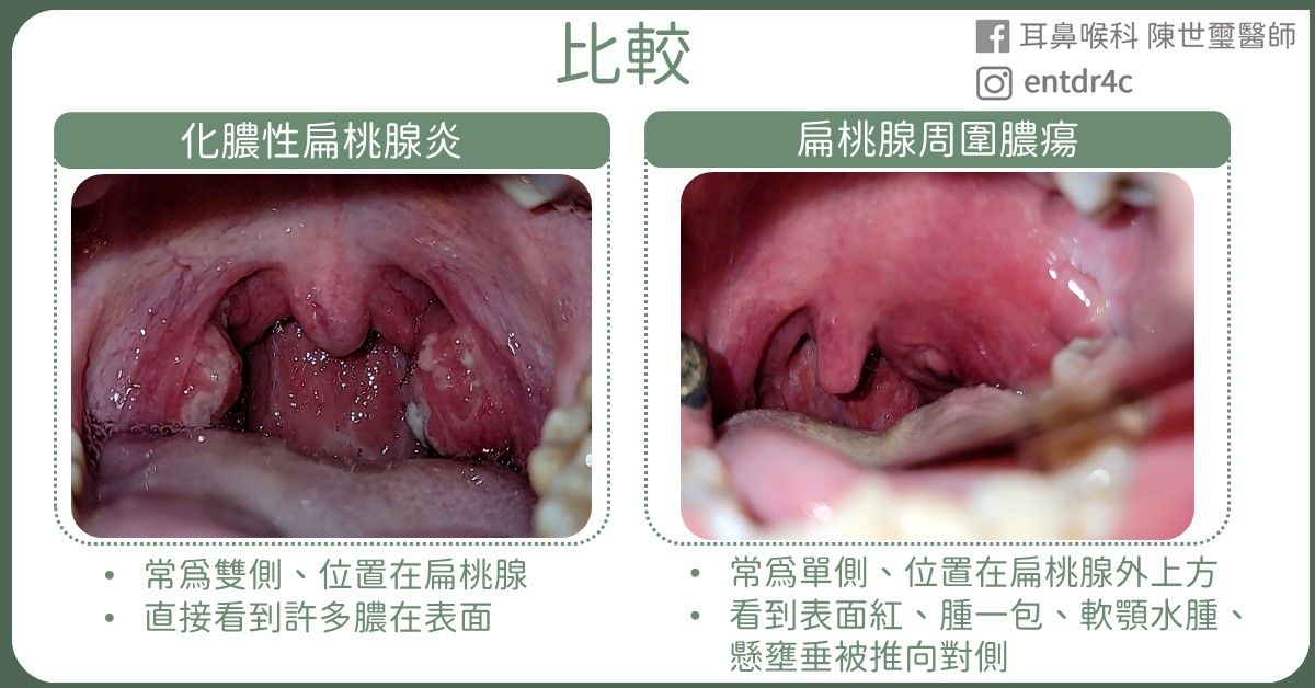 ▲▼他喉嚨痛當感冒！醫粗針一抽「臭黃膿狂湧」：嚴重恐致命。（圖／陳世璽醫師授權提供）