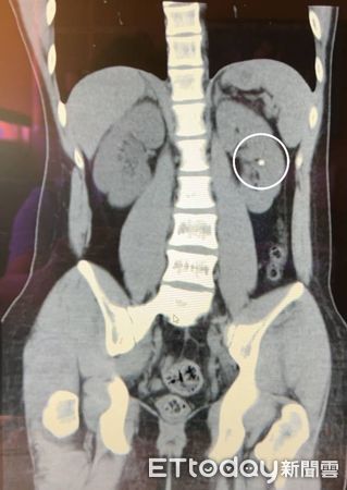 ▲高中生的左側腎臟有一顆0.6公分的結石。（圖／記者許宥孺翻攝）