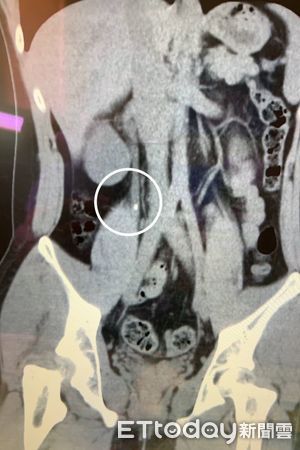 ▲右側輸尿管也有一顆0.55 公分的結石。（圖／記者許宥孺翻攝）