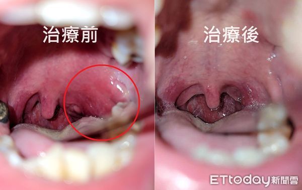 ▲▼他喉嚨痛當感冒！醫粗針一抽「臭黃膿狂湧」：嚴重恐致命。（圖／陳世璽醫師授權提供）