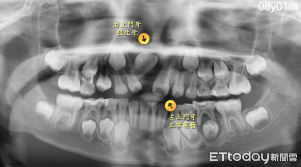 ▲▼8歲陳小弟的門牙向上往鼻孔生長。（圖／林詩詠醫師提供）