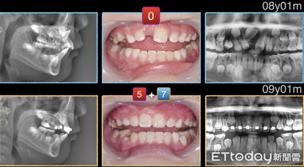 ▲▼8歲陳小弟的門牙向上往鼻孔生長。（圖／林詩詠醫師提供）