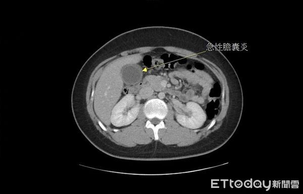 ▲國中弟愛吃炸雞！突「核彈級肚痛」掛急診　醫驚：幾乎快破裂。（圖／大千綜合醫院提供）