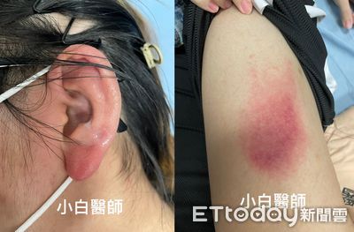 16歲妹穿耳洞「腫成豬耳朵」流出膿！細菌蔓延到大腿