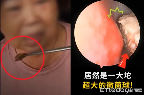 ▲一直聞到死鼠味！醫從鼻孔拖出「整坨黴菌球」　她秒驚：怎這麼多。（圖／陳亮宇醫師授權提供）