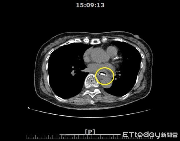▲蔡姓患者電腦斷層影像照，黃圈處即包含鋁箔包裝的藥片。（圖／衛福部南投醫院提供）