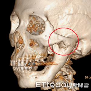 罕見「下顎骨」異常增生！婦嘴張不開　醫全台首例冷凍治療成功